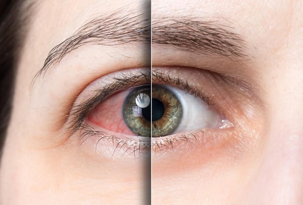 Khô mắt - Tình trạng phổ biến của nhiều người